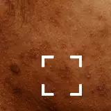 Skin Discoloration