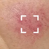 Sensitive Skin