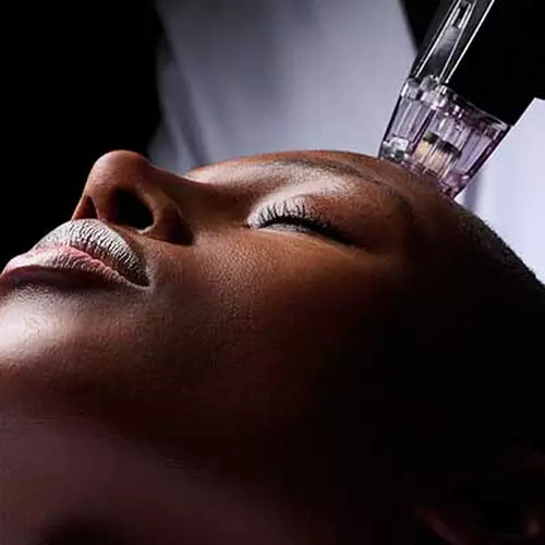 RF Microneedling Image