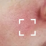 Redness Prone
