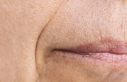 Skin Laxity SkinCeuticals