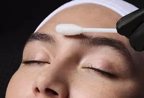 Deep Chemical Peel Banner