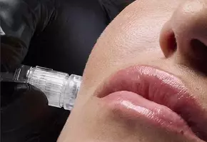 Microneedling Banner
