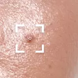 Oily Skin